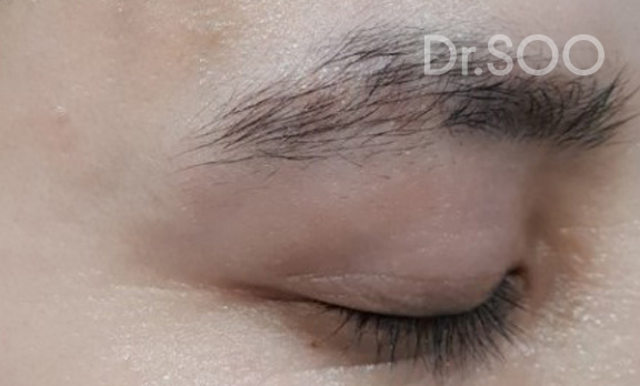 before 사진